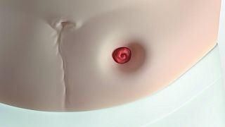 Die Stoma-Umgebung ist nach innen gewölbt und bildet eine Mulde.